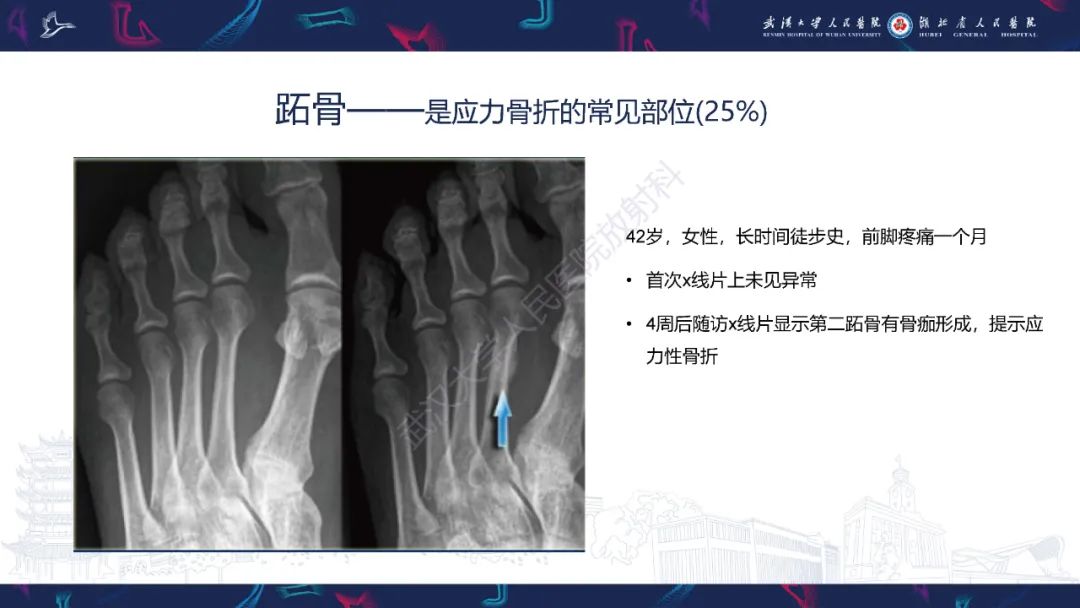 影像PPT - 一定要注意“可怕的黑线征”(dreaded black line)-29 影像PPT - 一定要注意“可怕的黑线征”(dreaded black line)-29