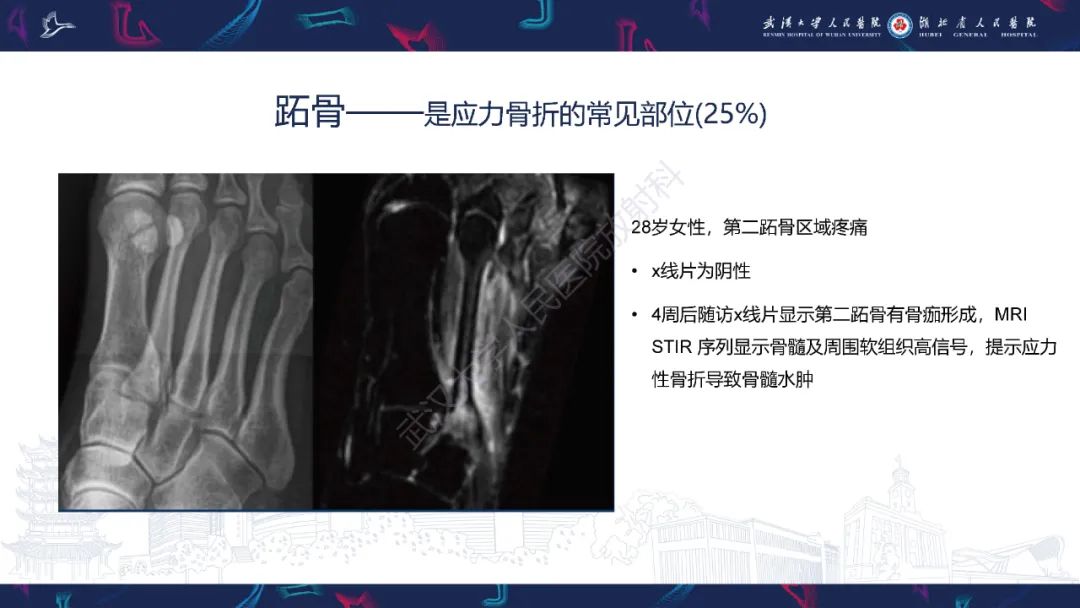 影像PPT - 一定要注意“可怕的黑线征”(dreaded black line)-30 影像PPT - 一定要注意“可怕的黑线征”(dreaded black line)-30