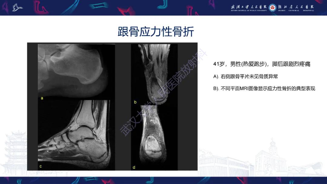 影像PPT - 一定要注意“可怕的黑线征”(dreaded black line)-31 影像PPT - 一定要注意“可怕的黑线征”(dreaded black line)-31