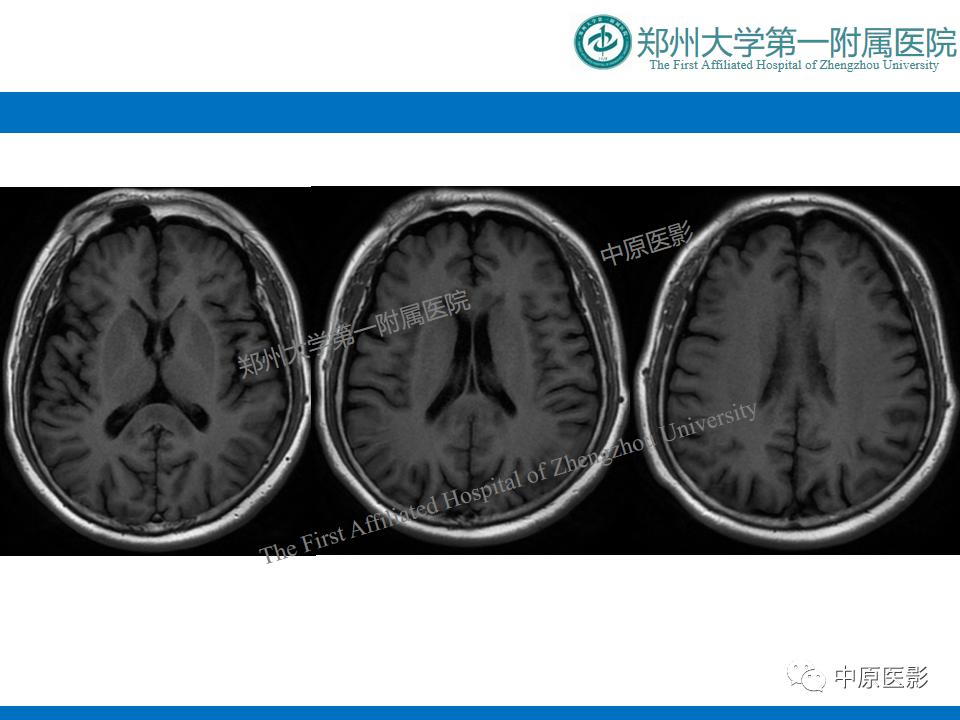 影像PPT - 【病例】酒精性胼胝体变性1例MR影像诊断-3
