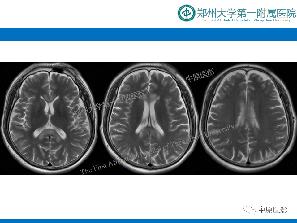 影像PPT - 【病例】酒精性胼胝体变性1例MR影像诊断-4