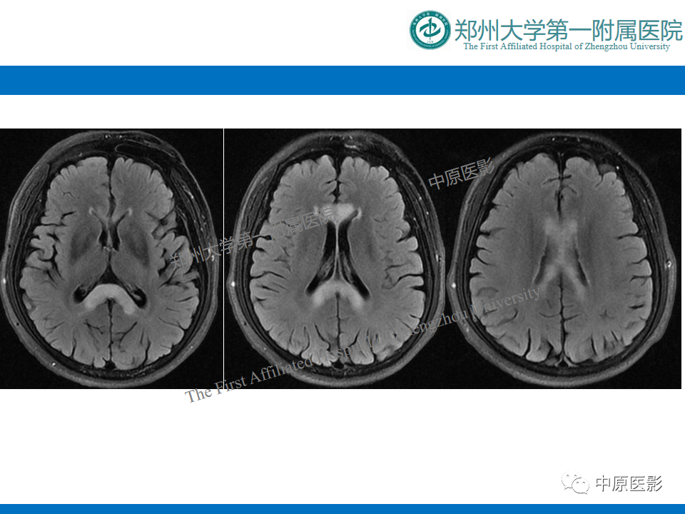 影像PPT - 【病例】酒精性胼胝体变性1例MR影像诊断-5