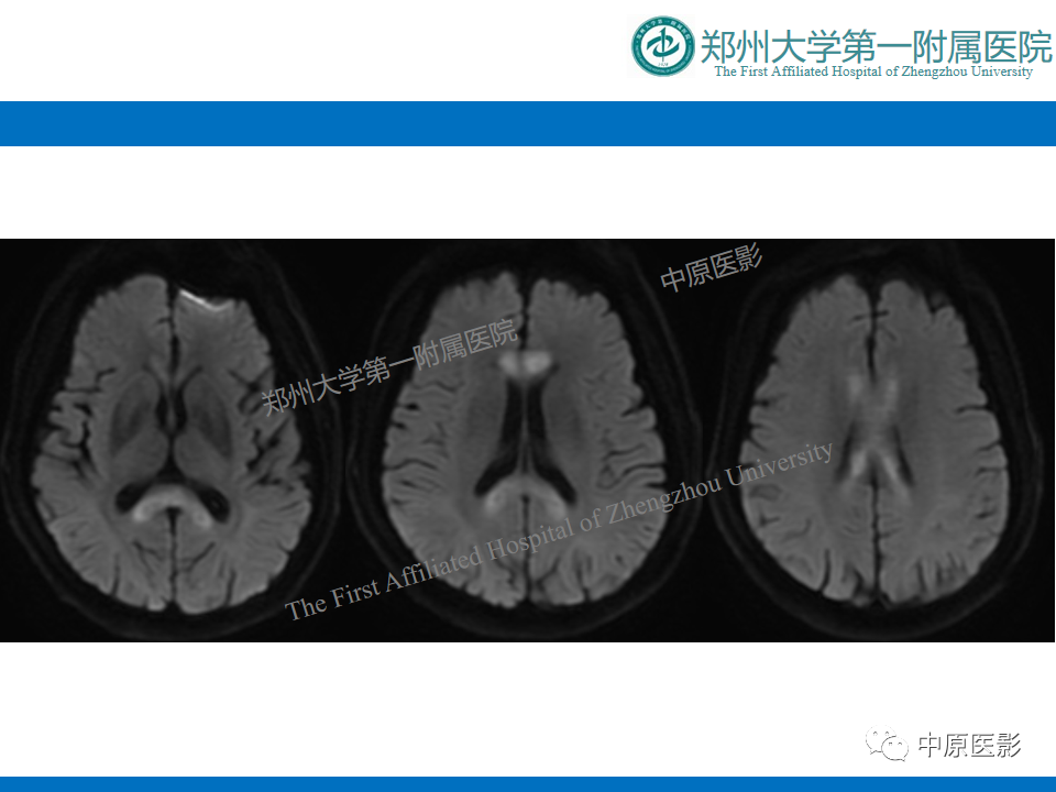 影像PPT - 【病例】酒精性胼胝体变性1例MR影像诊断-6