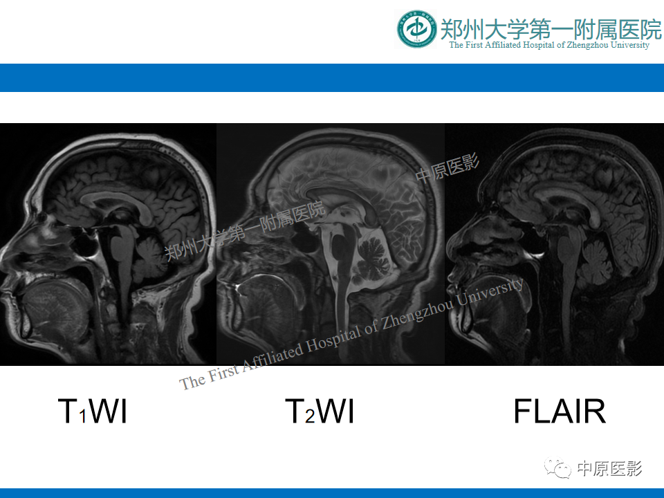 影像PPT - 【病例】酒精性胼胝体变性1例MR影像诊断-8