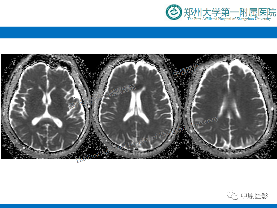 影像PPT - 【病例】酒精性胼胝体变性1例MR影像诊断-7