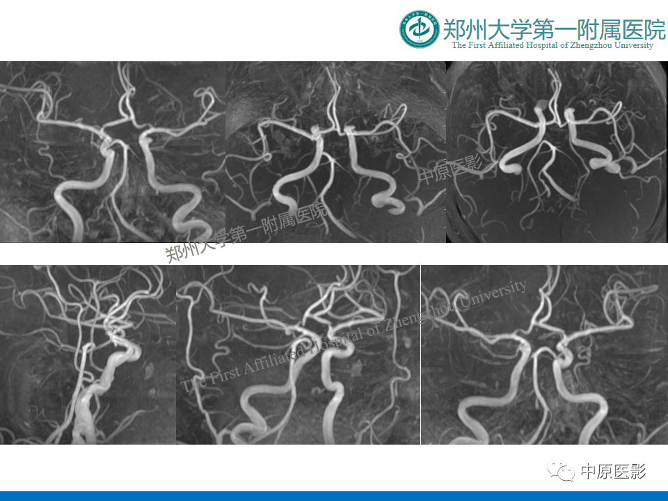 影像PPT - 【病例】酒精性胼胝体变性1例MR影像诊断-9