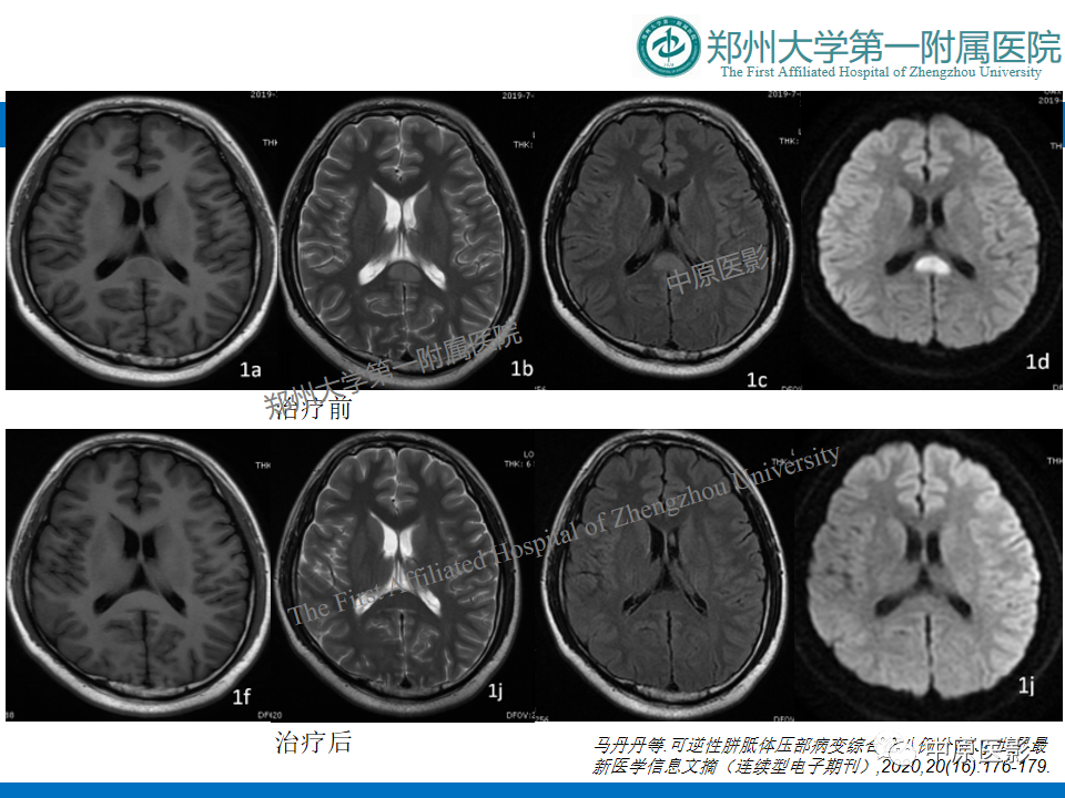 影像PPT - 【病例】酒精性胼胝体变性1例MR影像诊断-21