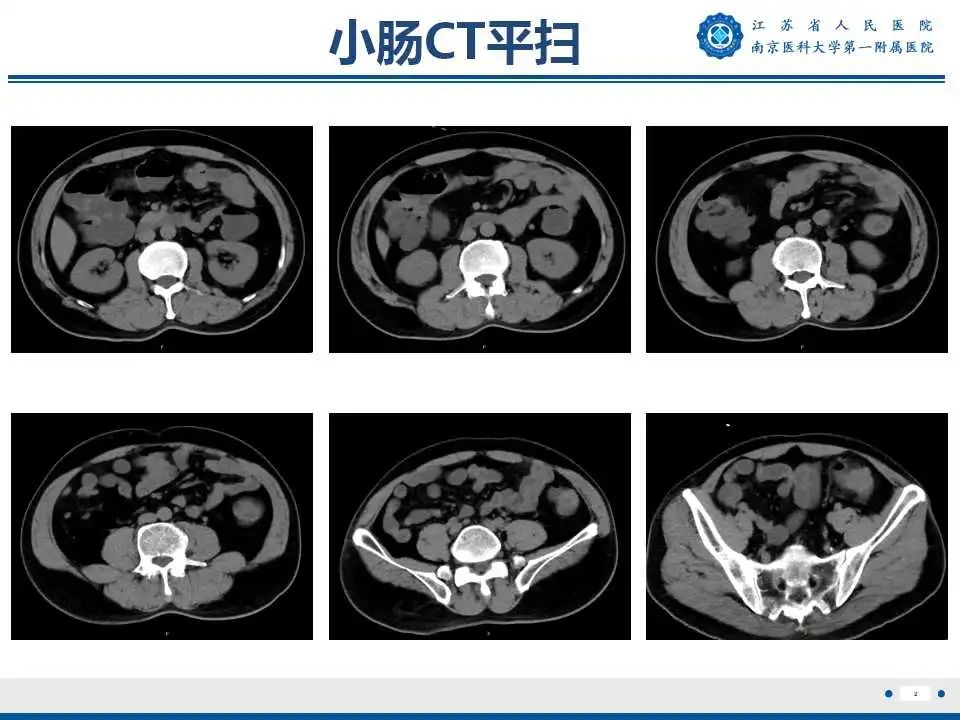 影像PPT - 【PPT】克罗恩病-3