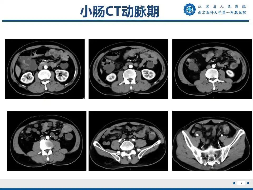 影像PPT - 【PPT】克罗恩病-4