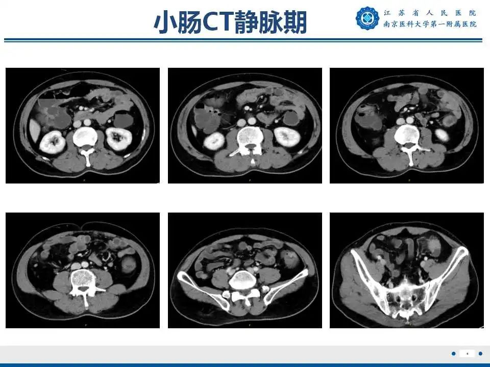 影像PPT - 【PPT】克罗恩病-5