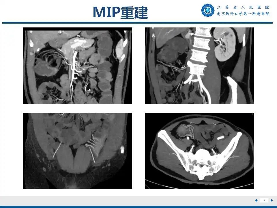 影像PPT - 【PPT】克罗恩病-7