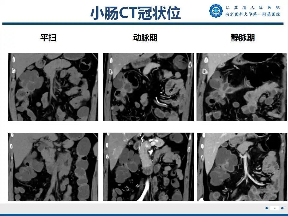 影像PPT - 【PPT】克罗恩病-6