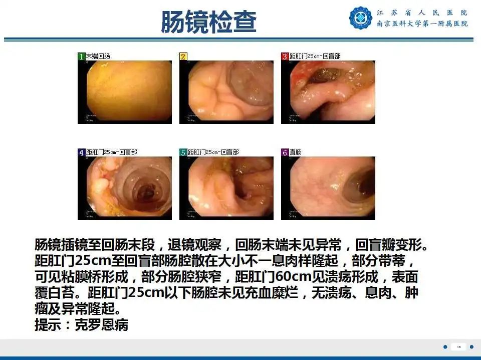影像PPT - 【PPT】克罗恩病-17