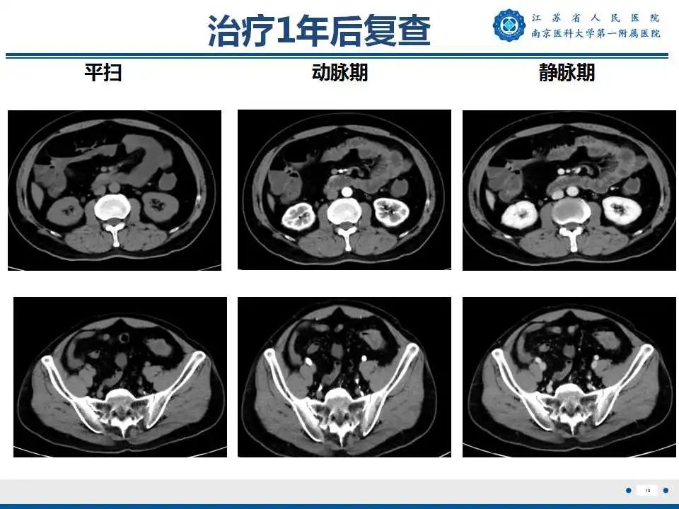 影像PPT - 【PPT】克罗恩病-19