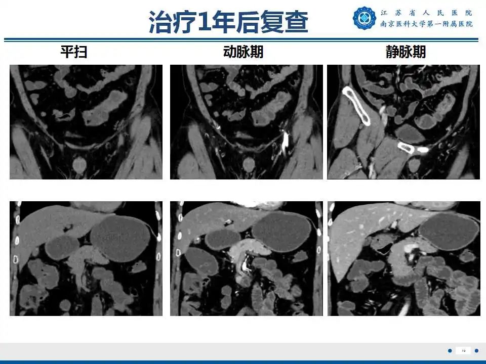 影像PPT - 【PPT】克罗恩病-20