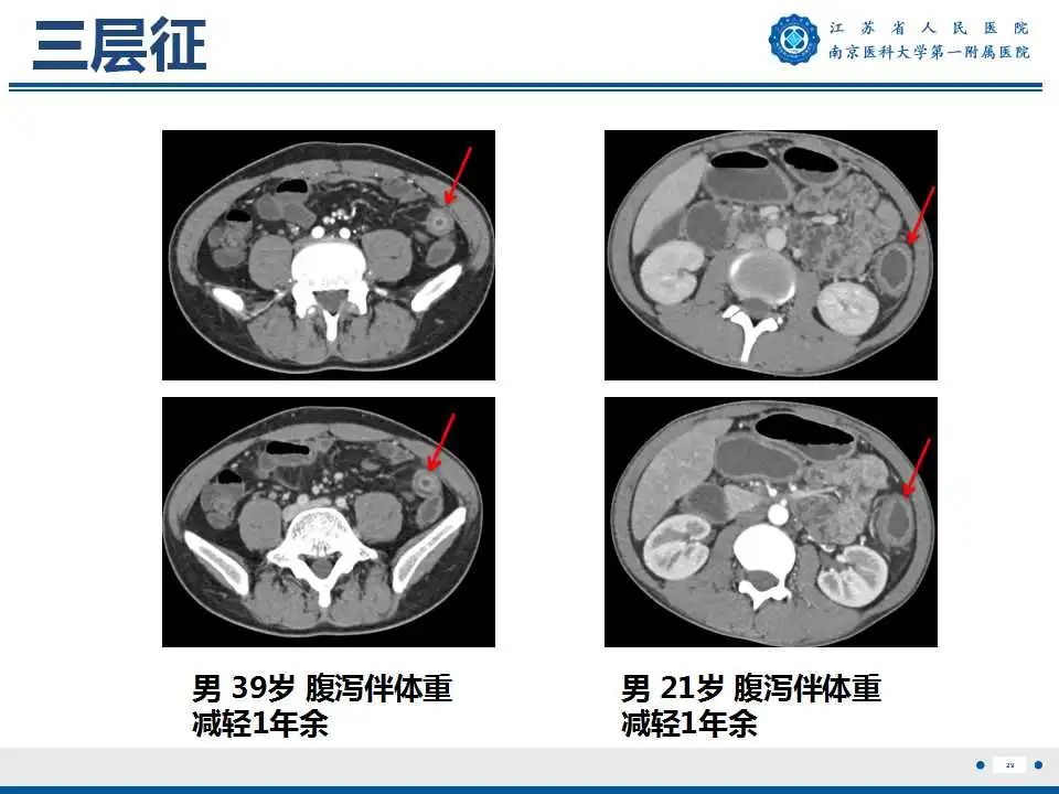 影像PPT - 【PPT】克罗恩病-30