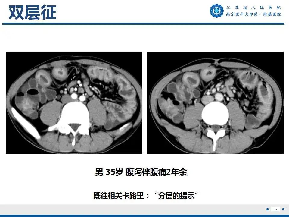 影像PPT - 【PPT】克罗恩病-31