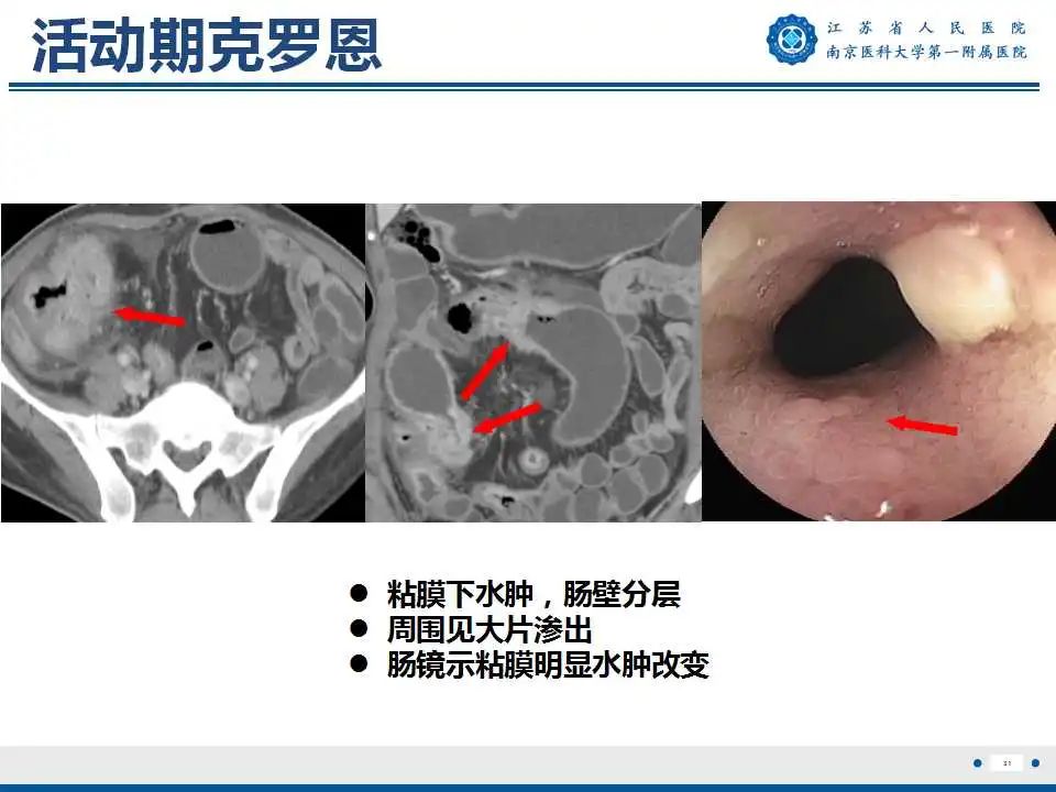影像PPT - 【PPT】克罗恩病-32