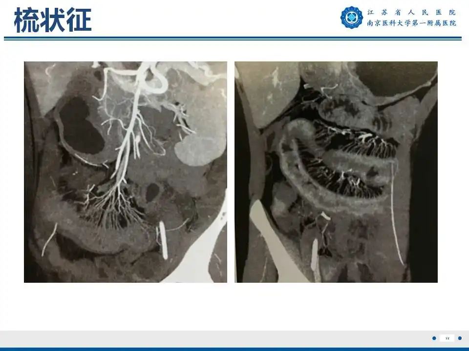 影像PPT - 【PPT】克罗恩病-33