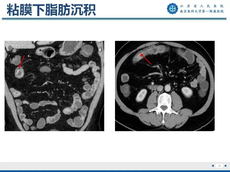 影像PPT - 【PPT】克罗恩病-35