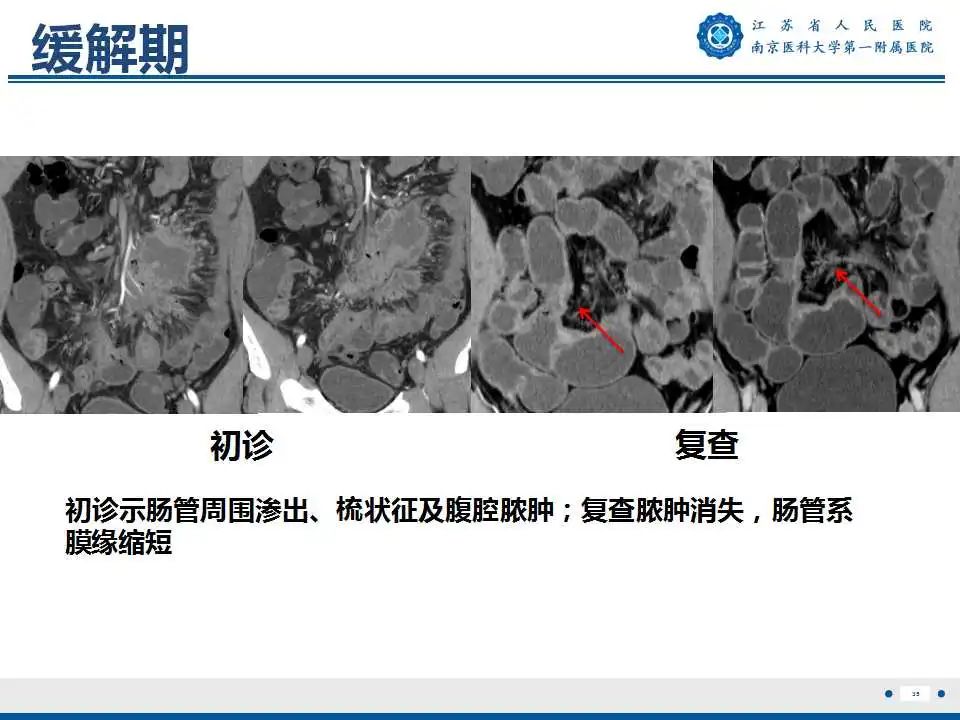 影像PPT - 【PPT】克罗恩病-36