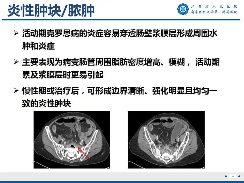 影像PPT - 【PPT】克罗恩病-39