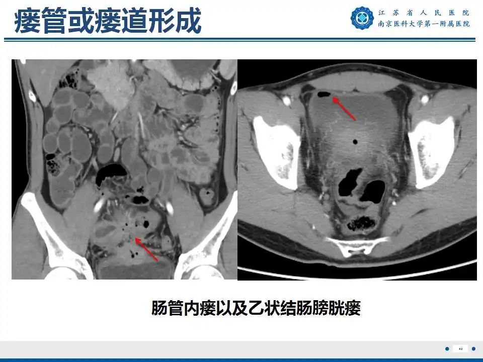 影像PPT - 【PPT】克罗恩病-41