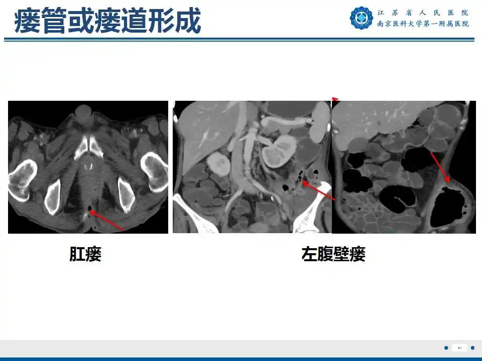 影像PPT - 【PPT】克罗恩病-42