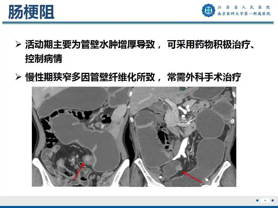 影像PPT - 【PPT】克罗恩病-43