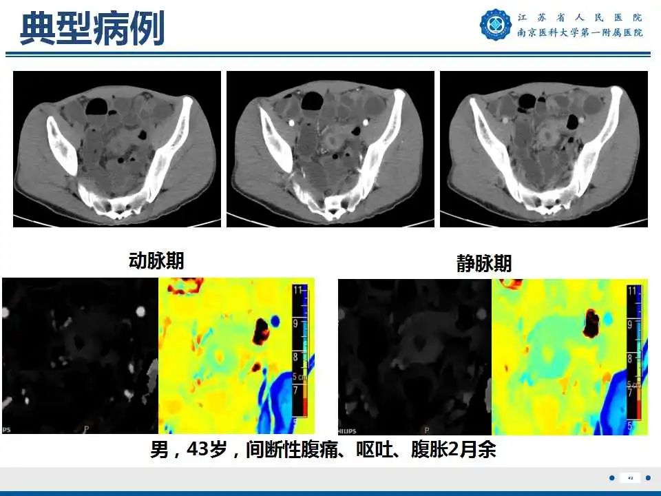影像PPT - 【PPT】克罗恩病-50