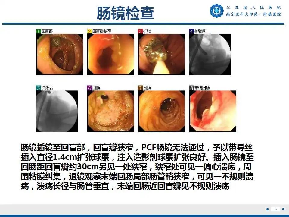 影像PPT - 【PPT】克罗恩病-52