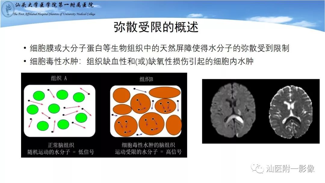 影像PPT - 【PPT】胼胝体弥散受限病变的MRI诊断思路-4