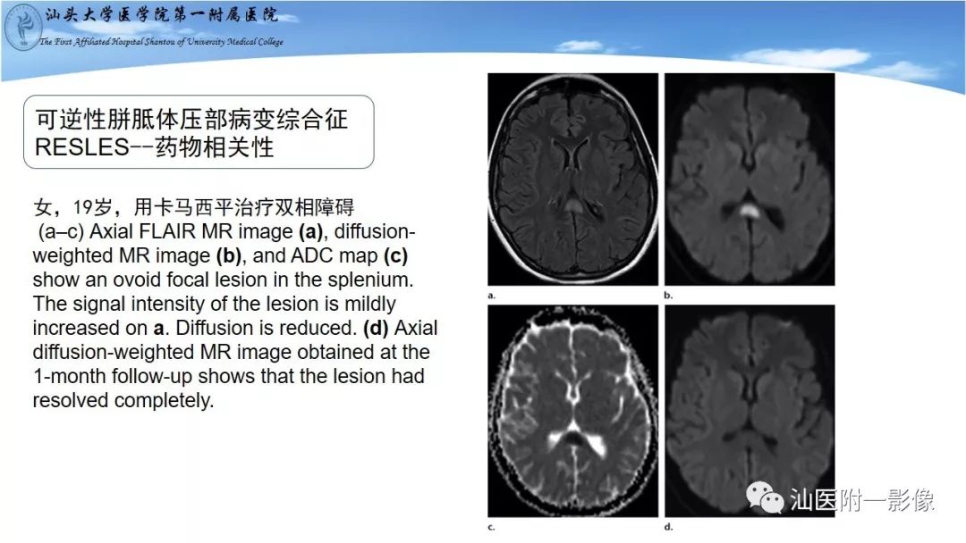 影像PPT - 【PPT】胼胝体弥散受限病变的MRI诊断思路-9