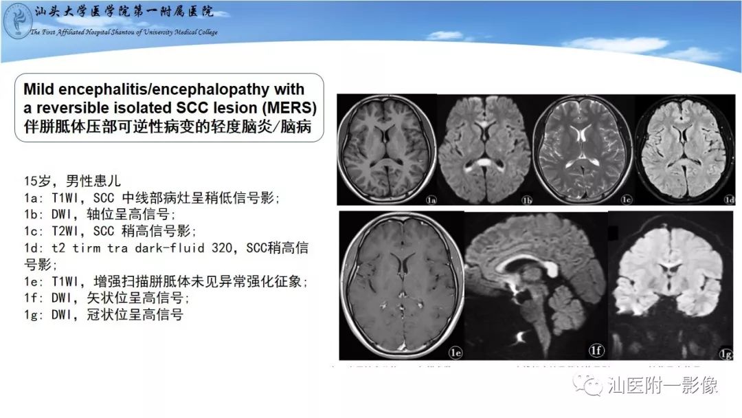 影像PPT - 【PPT】胼胝体弥散受限病变的MRI诊断思路-10