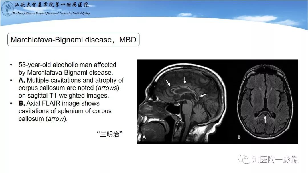 影像PPT - 【PPT】胼胝体弥散受限病变的MRI诊断思路-12