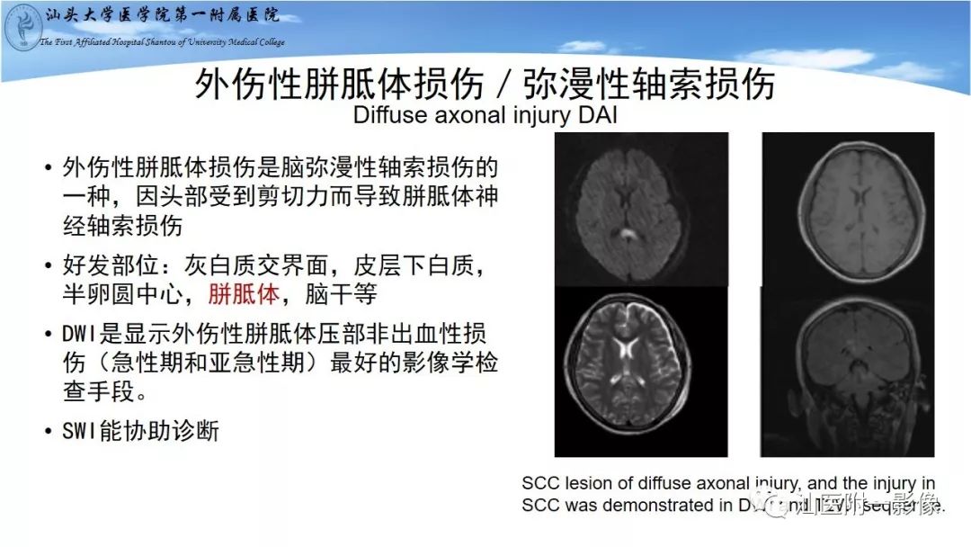 影像PPT - 【PPT】胼胝体弥散受限病变的MRI诊断思路-13