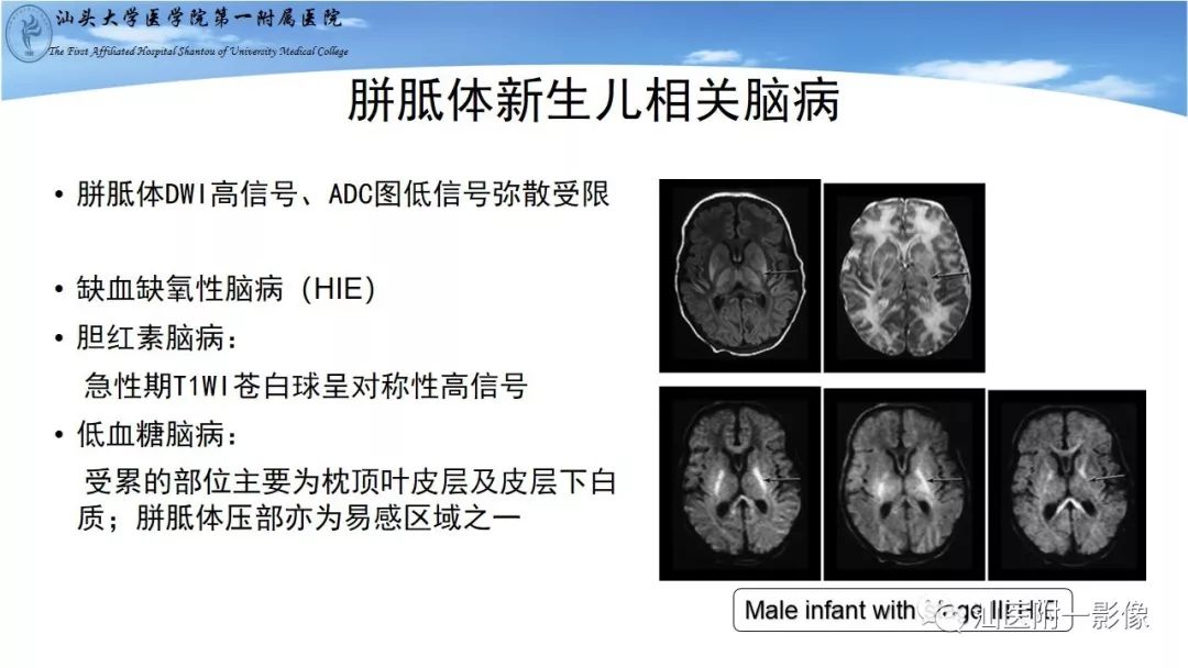 影像PPT - 【PPT】胼胝体弥散受限病变的MRI诊断思路-14