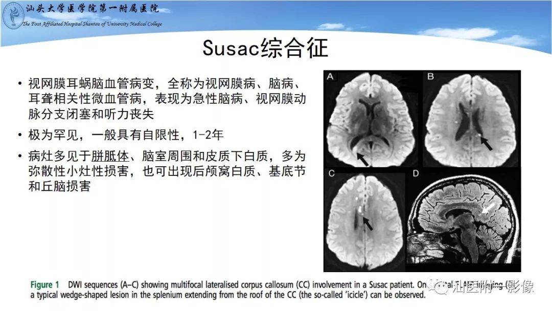 影像PPT - 【PPT】胼胝体弥散受限病变的MRI诊断思路-16