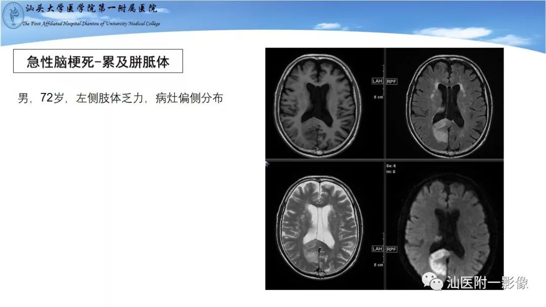 影像PPT - 【PPT】胼胝体弥散受限病变的MRI诊断思路-25