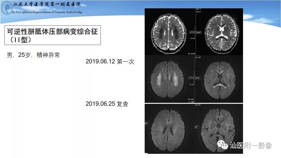 影像PPT - 【PPT】胼胝体弥散受限病变的MRI诊断思路-23