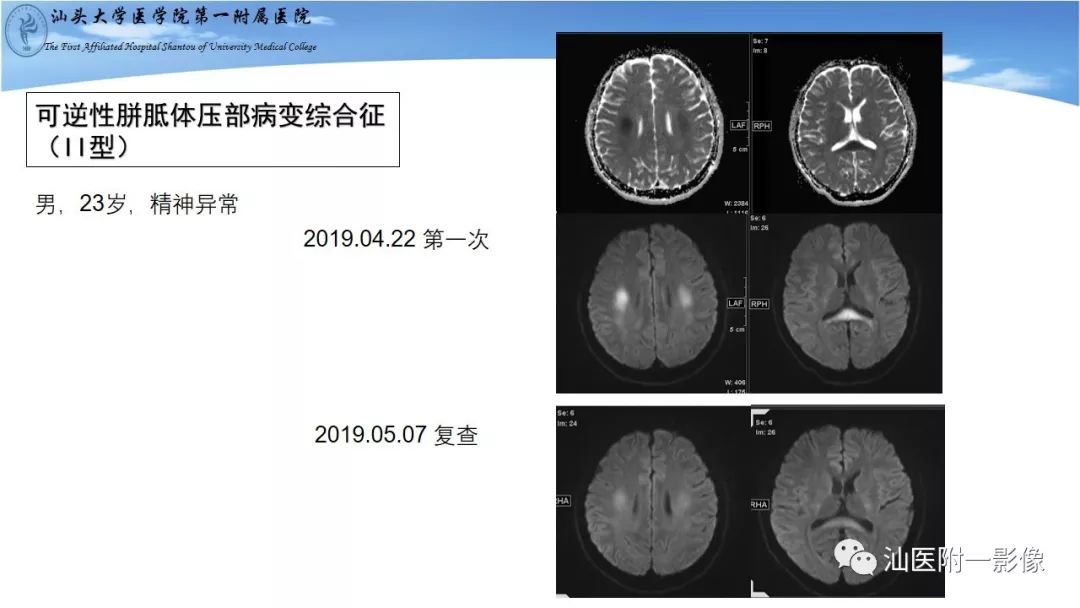 影像PPT - 【PPT】胼胝体弥散受限病变的MRI诊断思路-22