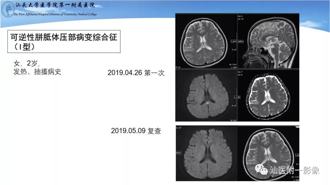 影像PPT - 【PPT】胼胝体弥散受限病变的MRI诊断思路-21