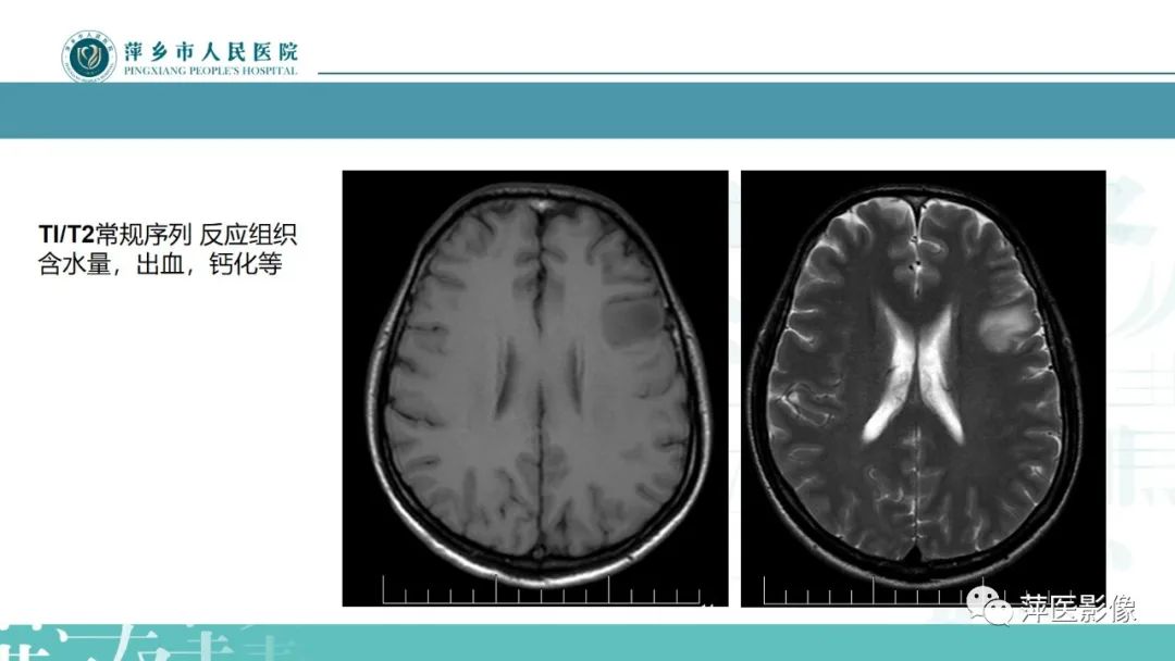 影像PPT - 【PPT】弥漫性胶质瘤MRI表现及鉴别诊断-4