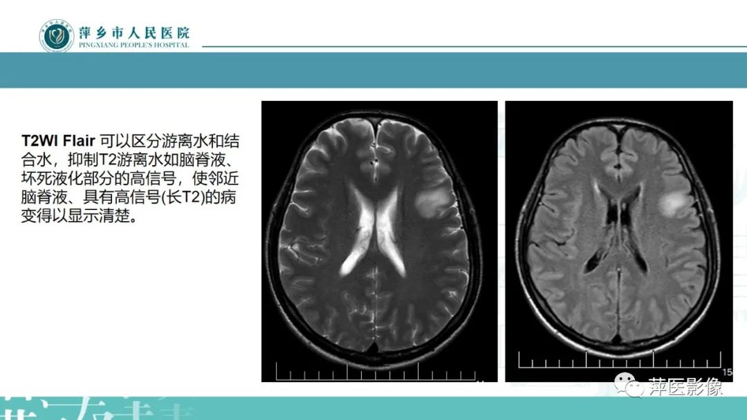 影像PPT - 【PPT】弥漫性胶质瘤MRI表现及鉴别诊断-5