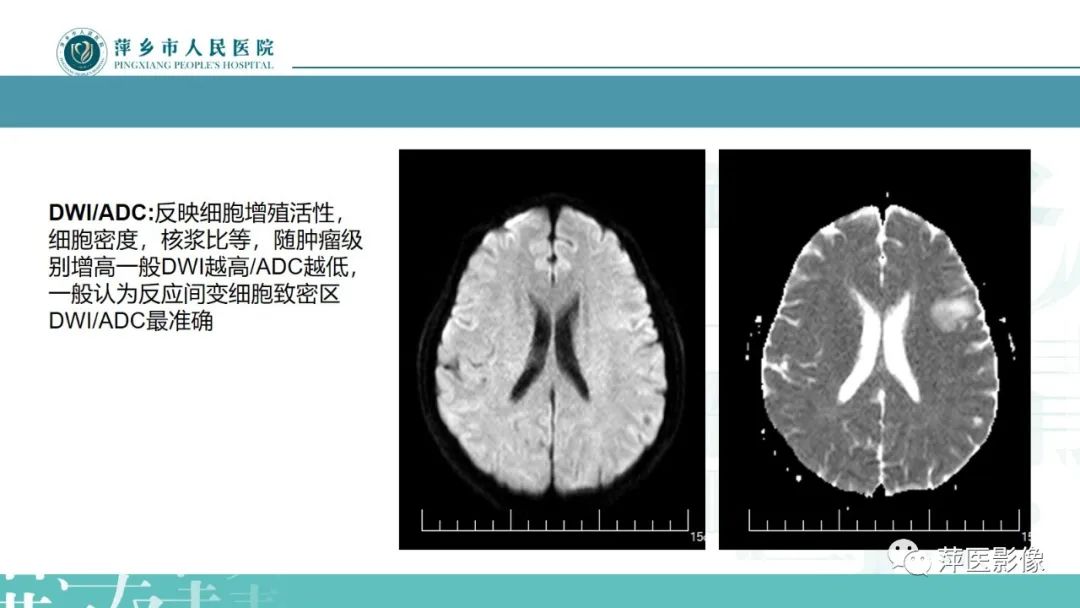 影像PPT - 【PPT】弥漫性胶质瘤MRI表现及鉴别诊断-6