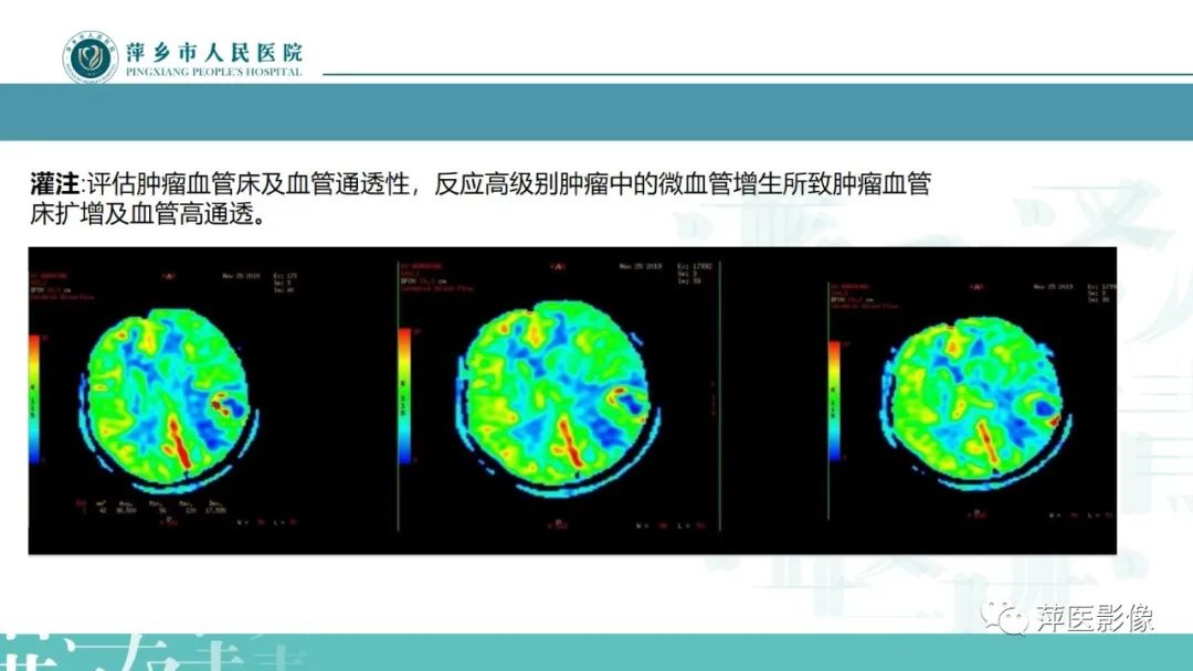 影像PPT - 【PPT】弥漫性胶质瘤MRI表现及鉴别诊断-8