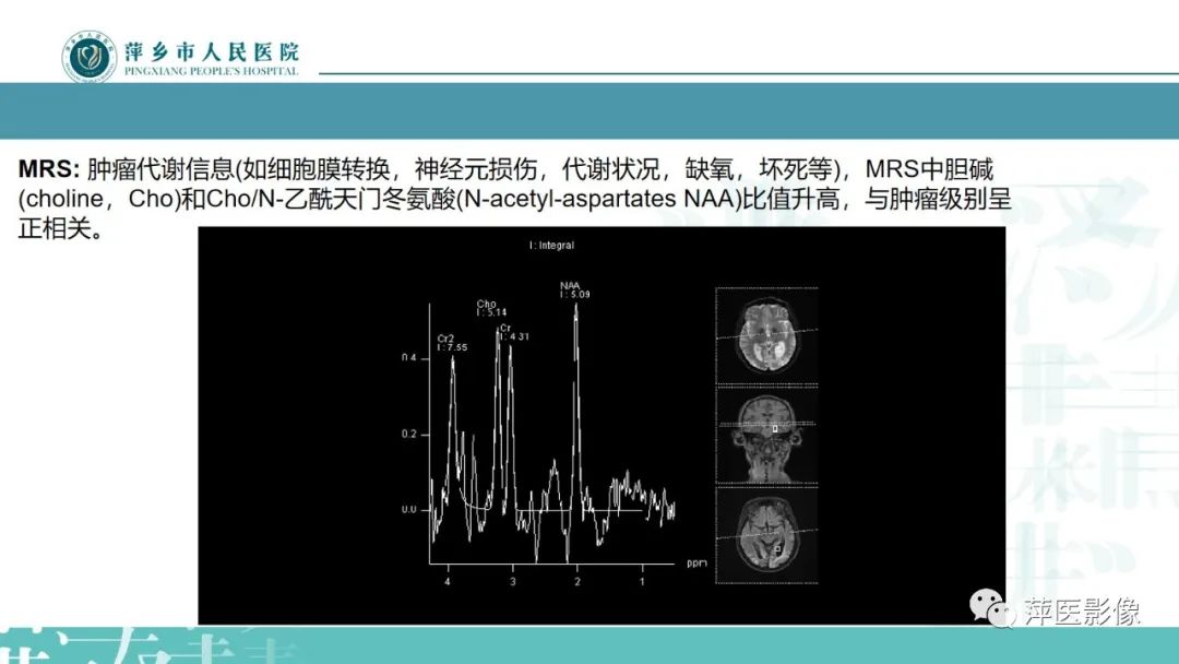 影像PPT - 【PPT】弥漫性胶质瘤MRI表现及鉴别诊断-9
