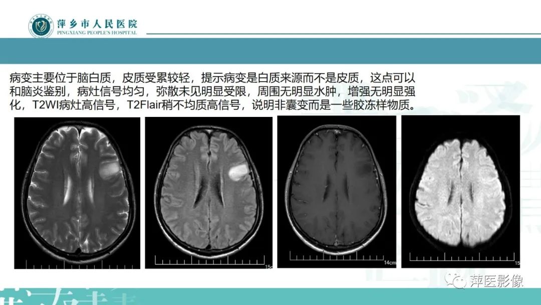 影像PPT - 【PPT】弥漫性胶质瘤MRI表现及鉴别诊断-12