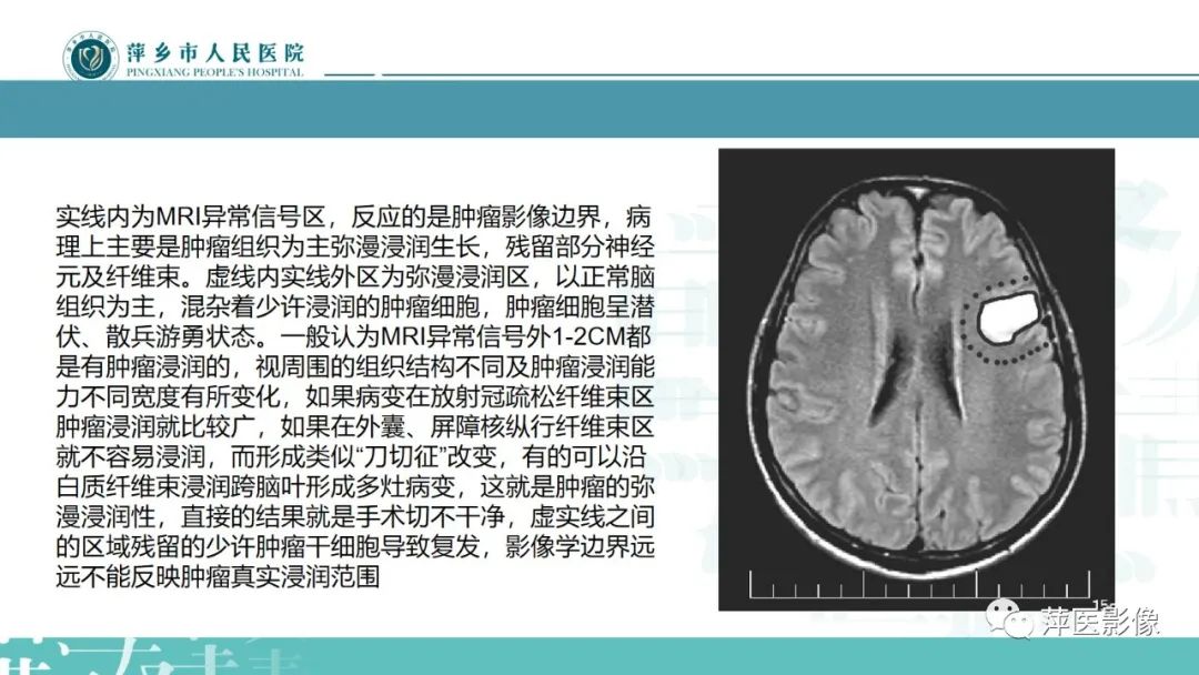 影像PPT - 【PPT】弥漫性胶质瘤MRI表现及鉴别诊断-13