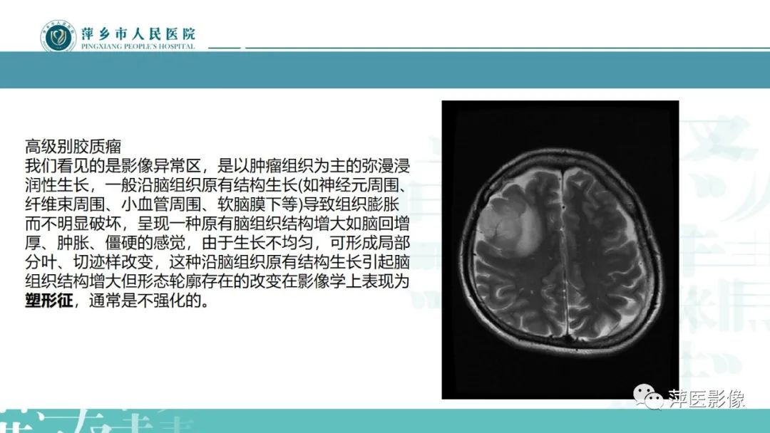 影像PPT - 【PPT】弥漫性胶质瘤MRI表现及鉴别诊断-14